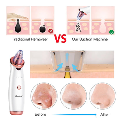 CkeyiN Electric Blackhead Remover Vacuum Facial Acne Cleaner Pimple Pore Cleansing Device Black Nose Point Beauty Skin Care Tool